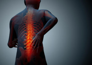Posterior Lumbar Decompression and Fusion NYC | Lumbar Spine Surgery