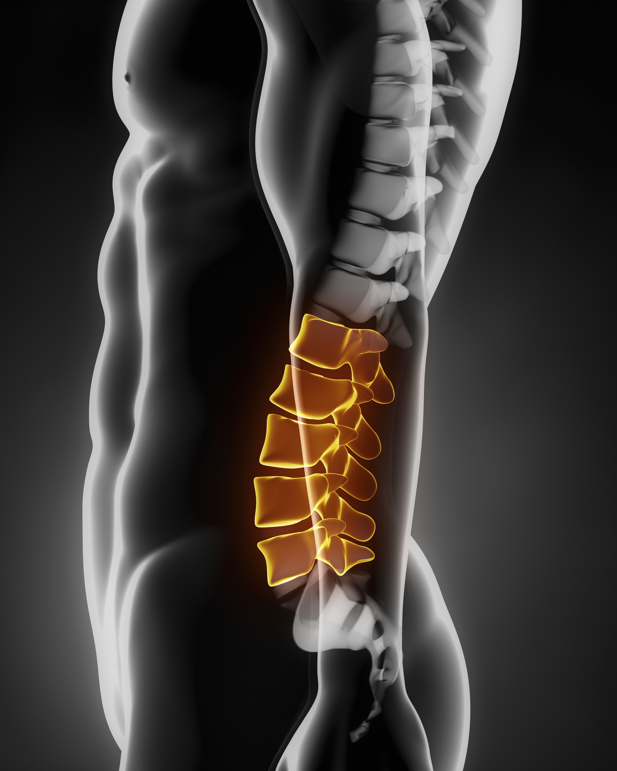 Lumbar Spine Surgery | Lower Back Surgery NYC | Manhattan New York 