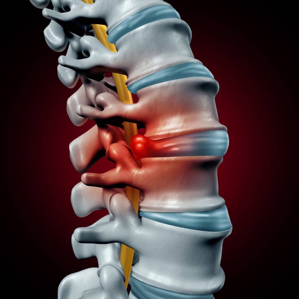 3d-rendered spine with spinal disc highlighted red to represent pain from disc compression