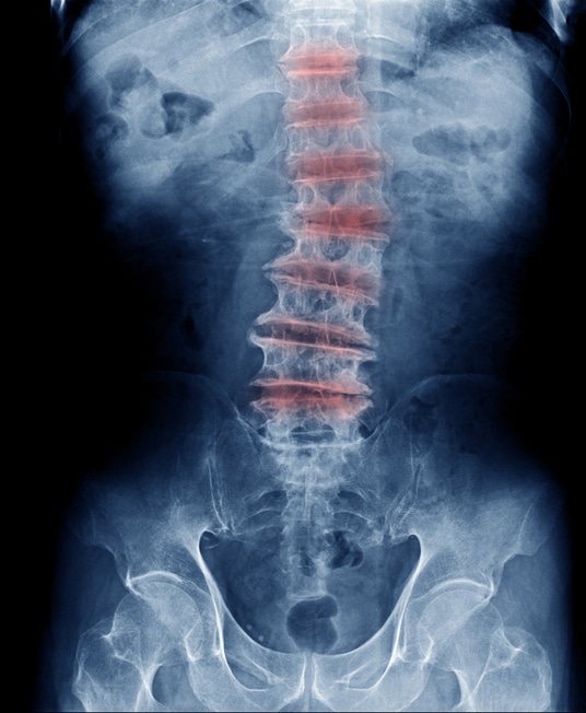 x-ray of human spine with discs highlighted red to represent pain from spinal conditions