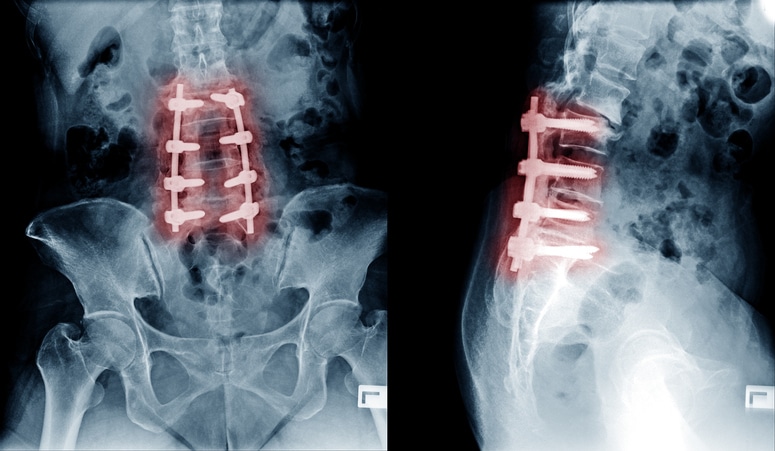 Posterior Lumbar Decompression and Fusion Surgery