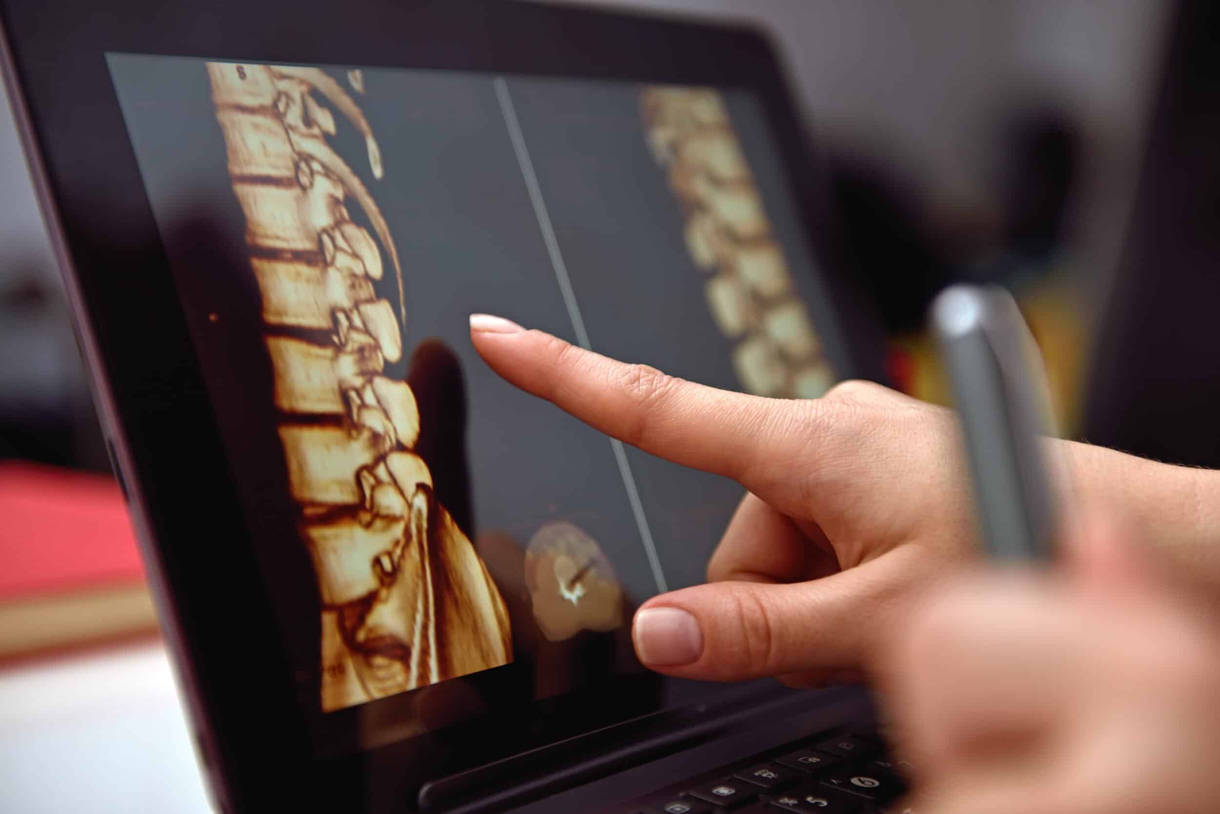 Doctor examines images of patient's spine on his computer.